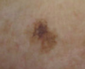 Melanoma