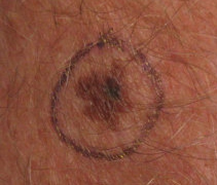 Melanoma
