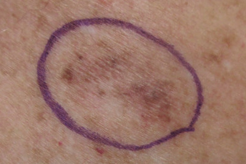 Melanoma