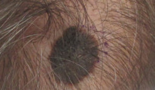 Melanoma