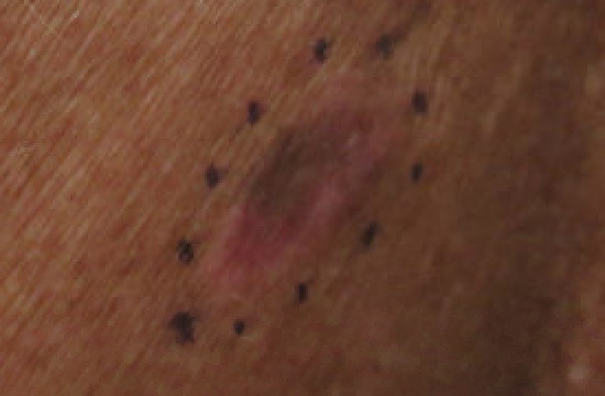 Melanoma