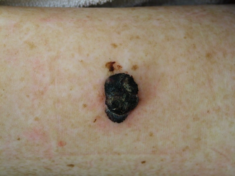 Melanoma