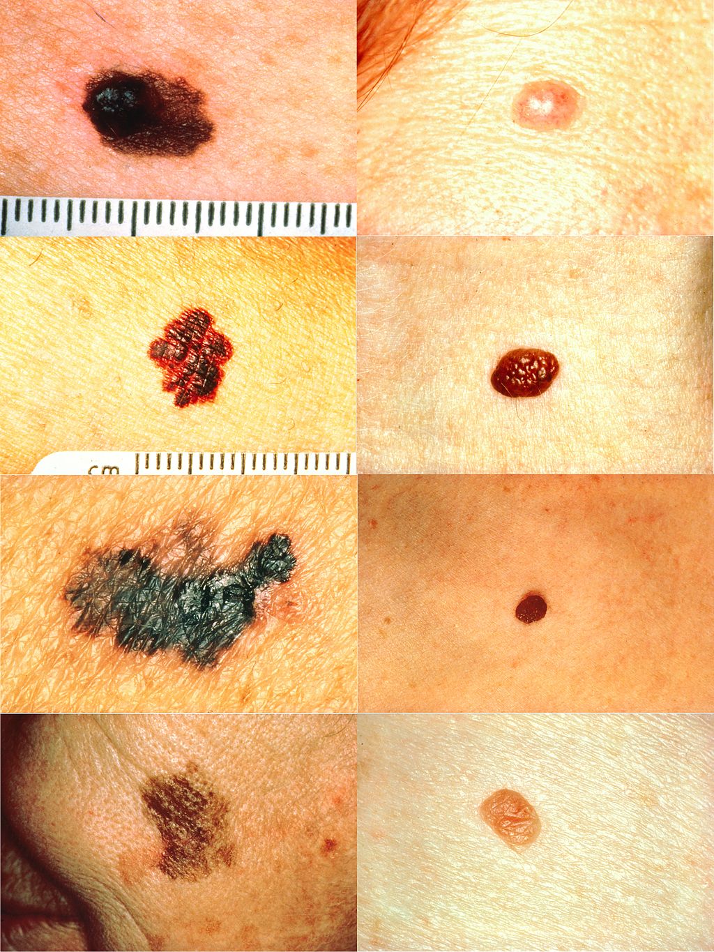 Melanoma