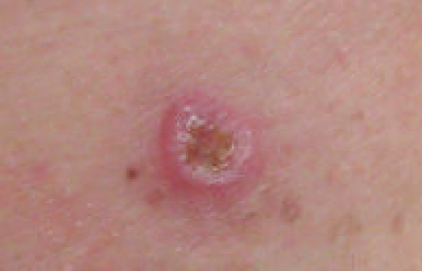 Melanoma