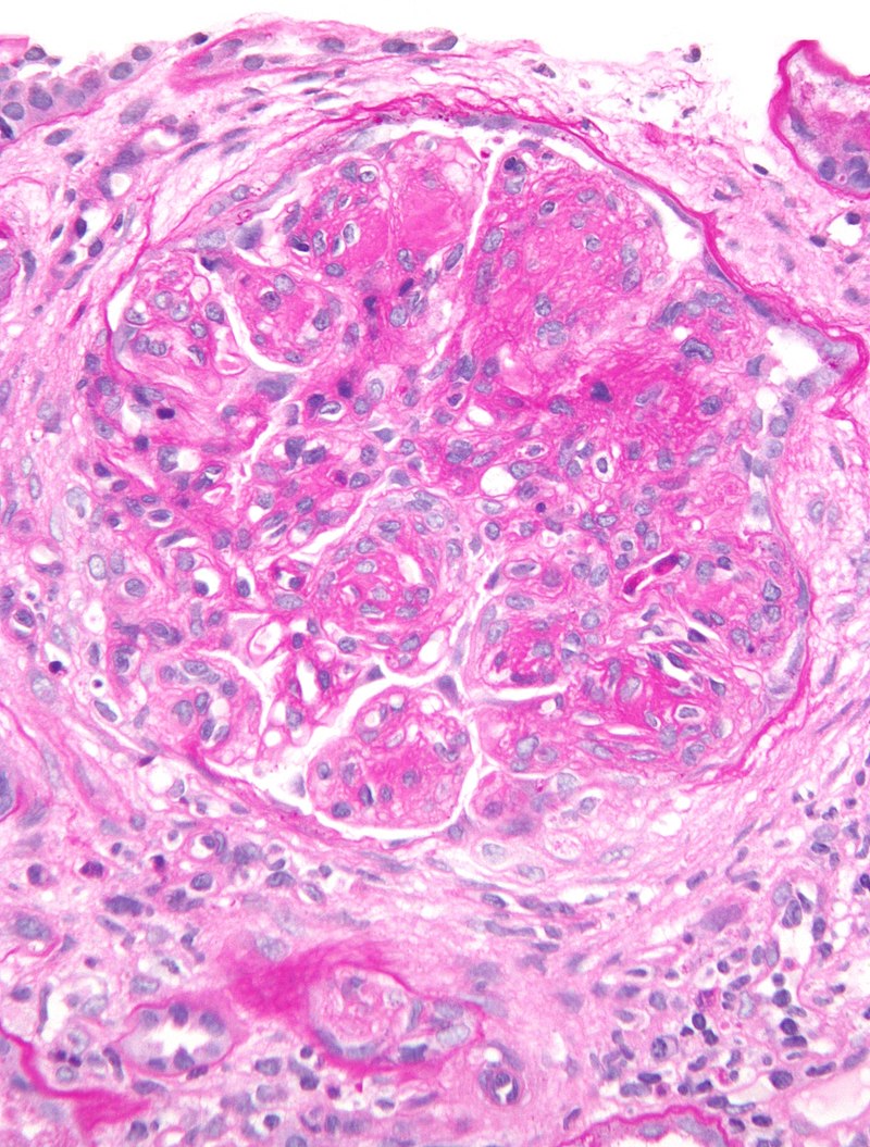 Membranoproliferative Glomerulonephritis