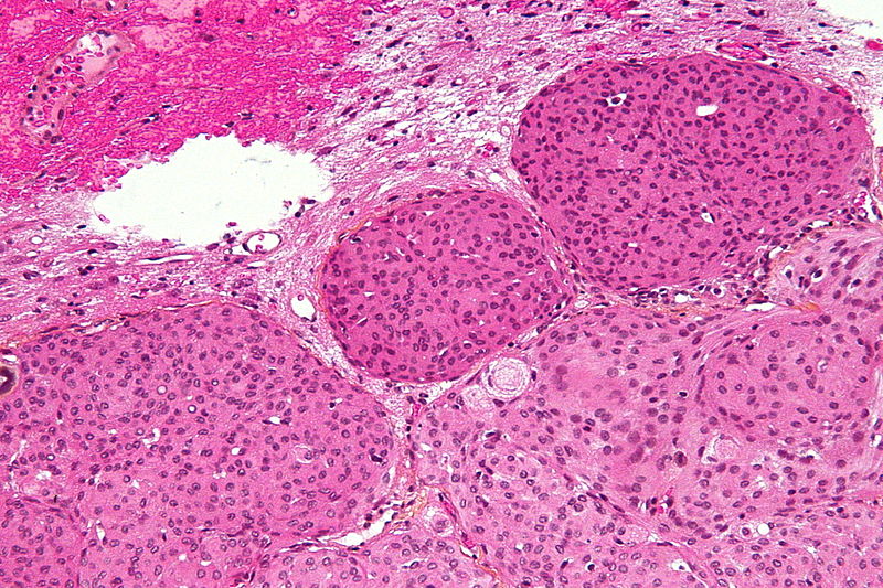 Meningioma