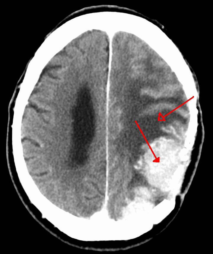Meningioma