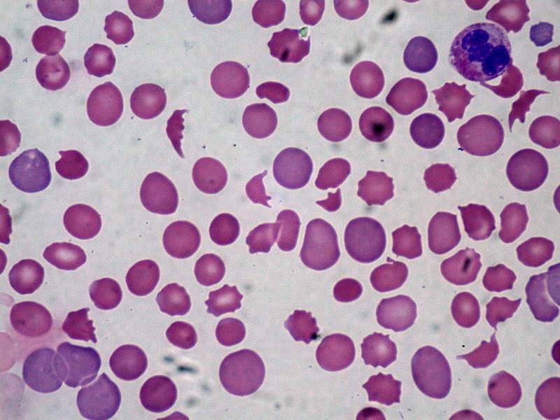 Microangiopathic Hemolytic Anemia