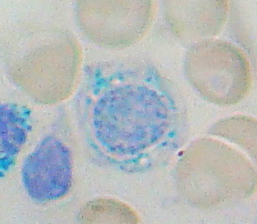 Sideroblastic Anemia