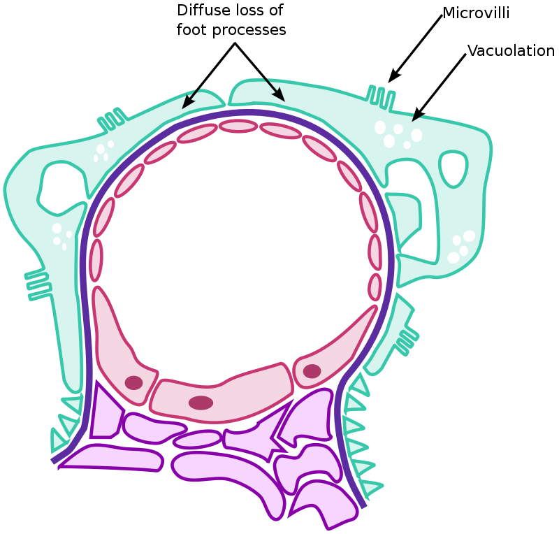 Minimal Change Disease