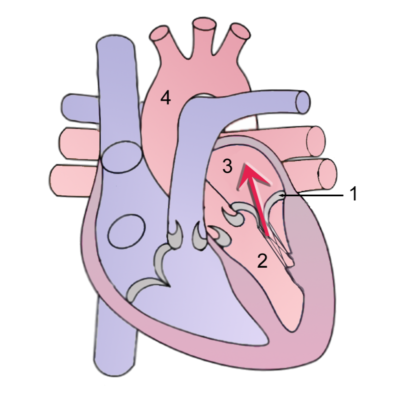 Mitral Regurgitation