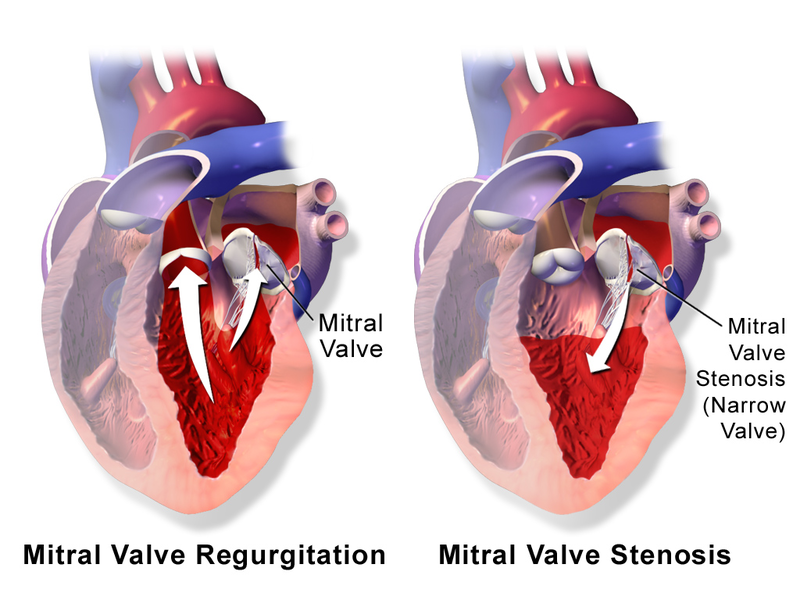 Mitral Regurgitation