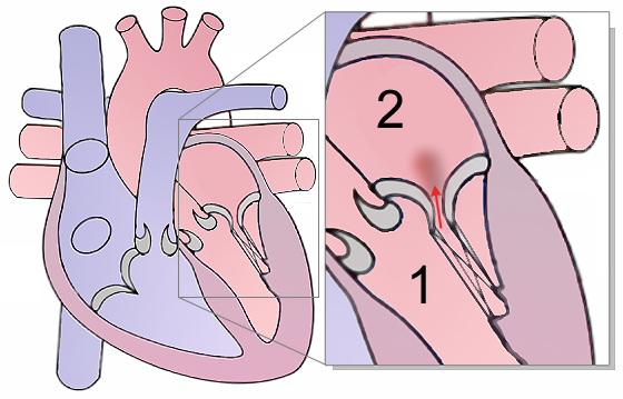 Mitral Regurgitation