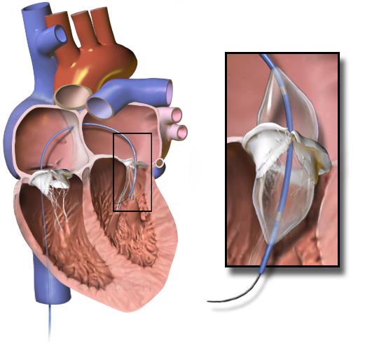 Mitral Stenosis