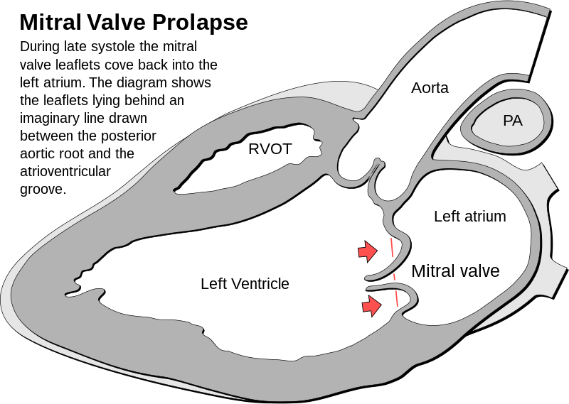 Mitral Valve Prolapse
