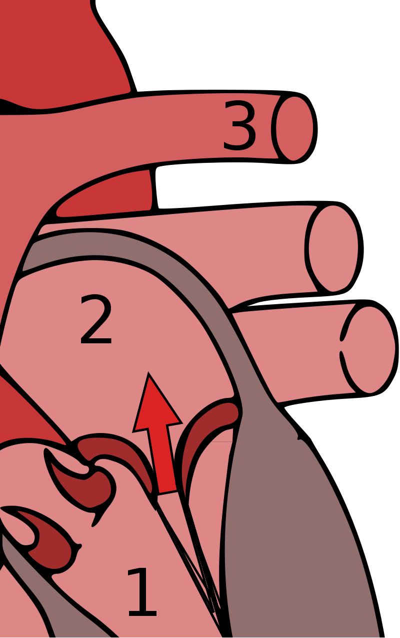Mitral Valve Prolapse