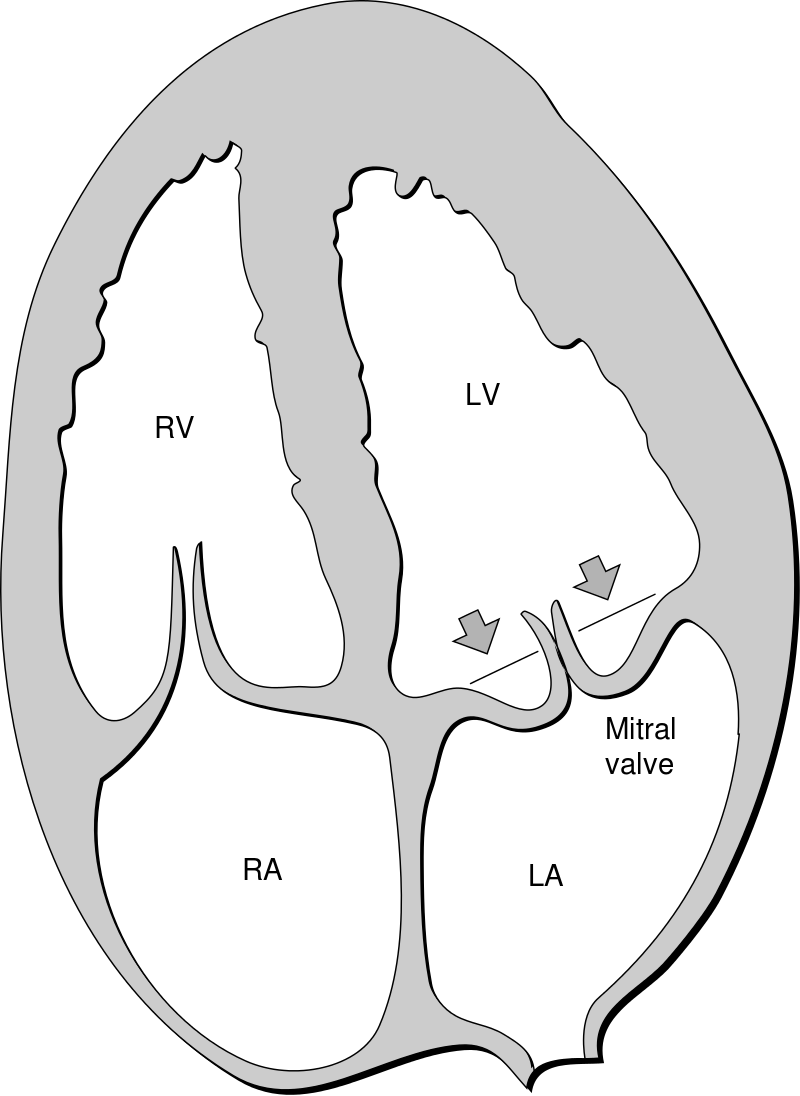 Mitral Valve Prolapse
