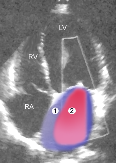 Mitral regurgitation