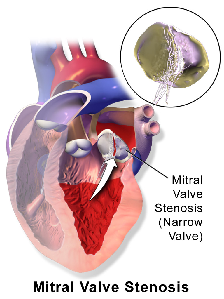 Mitral stenosis