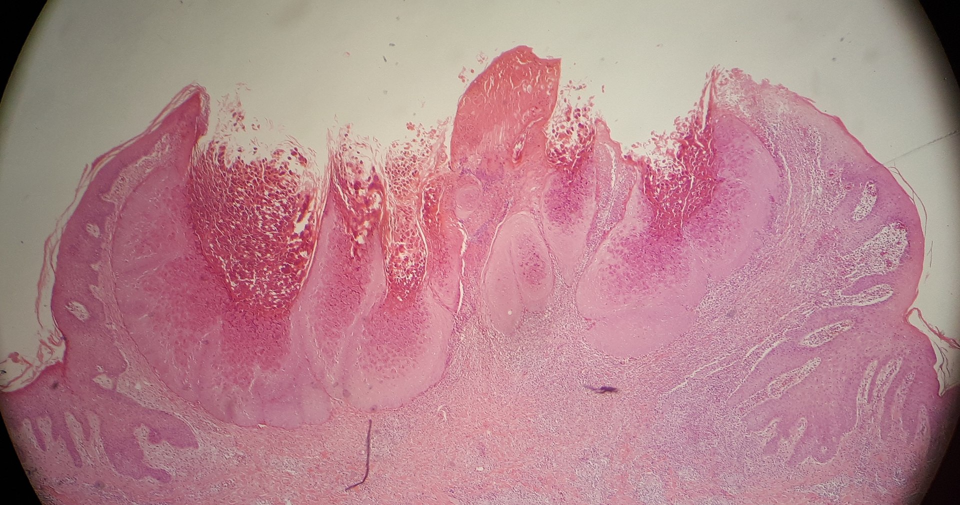 Molluscum Contagiosum