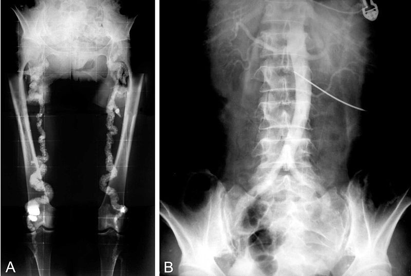 Monckeberg Medial Calcific Sclerosis