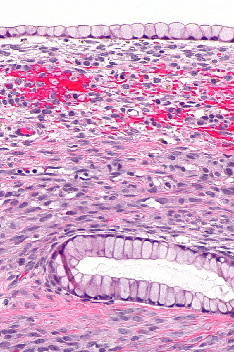 Mucinous Carcinoma