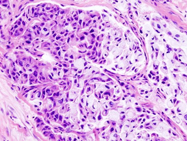 Mucoepidermoid Carcinoma