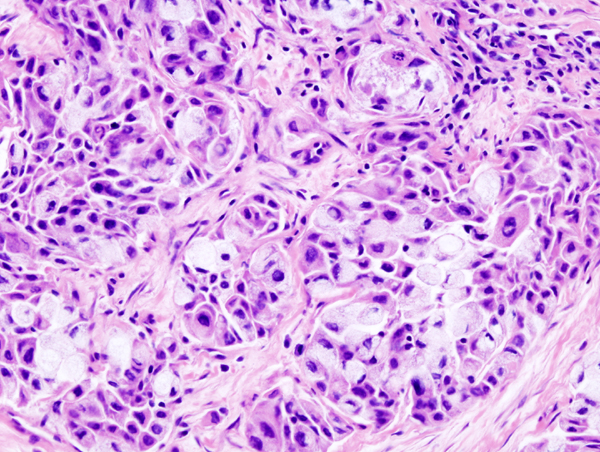 Mucoepidermoid Carcinoma
