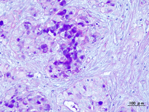 Mucoepidermoid Carcinoma