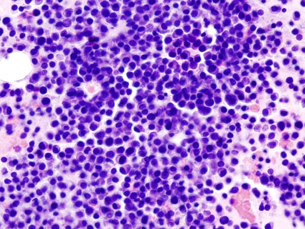 Multiple Myeloma