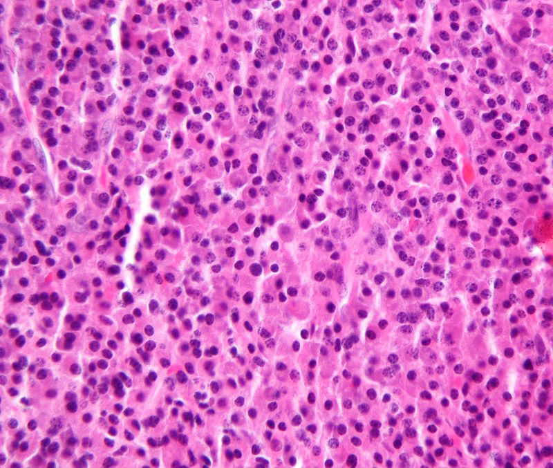 Multiple Myeloma