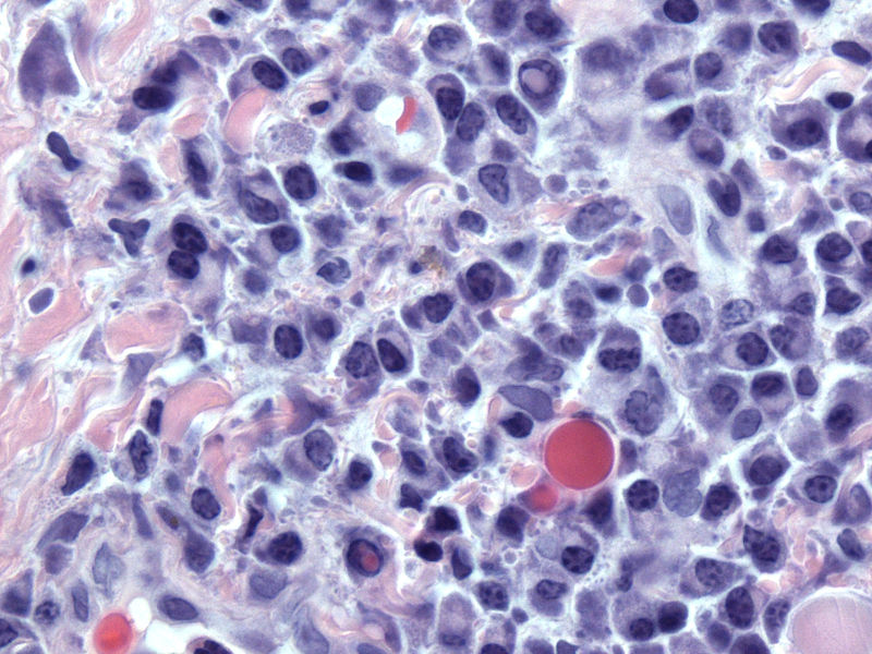 Multiple Myeloma