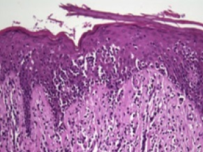 Mycosis Fungoides