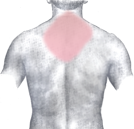 Myocardial Infarction