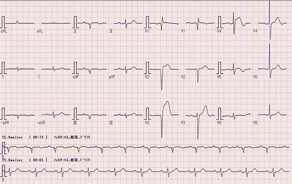 Myocardial Infarction