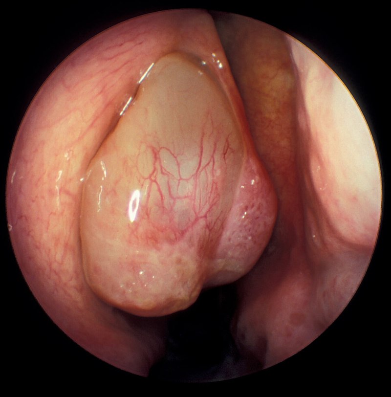 Nasal Polyp