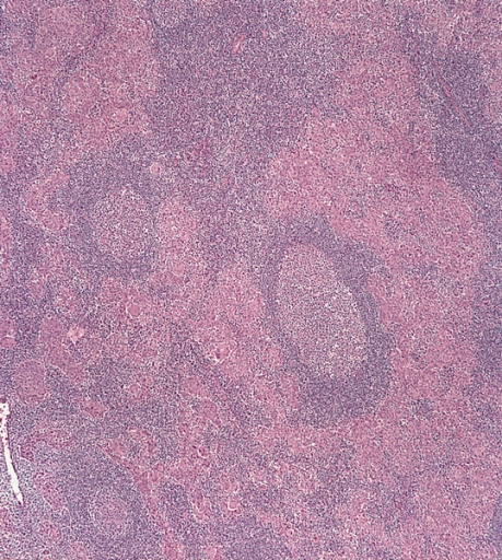 Nasopharyngeal Carcinoma
