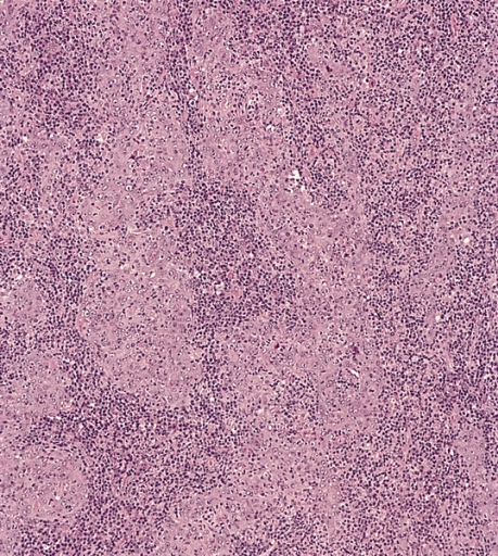 Nasopharyngeal Carcinoma