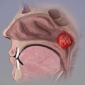 Nasopharynx and Larynx Pathology