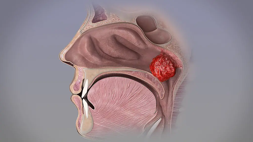 Nasopharynx and Larynx Pathology