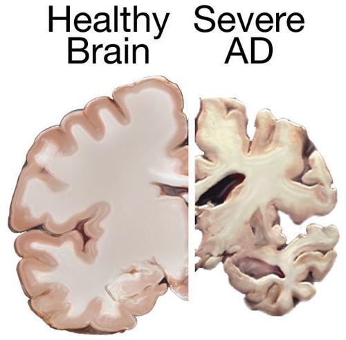 Neurodegenerative Disorders