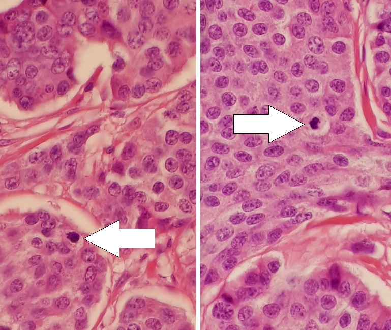 Neuroendocrine Tumor of the Lung