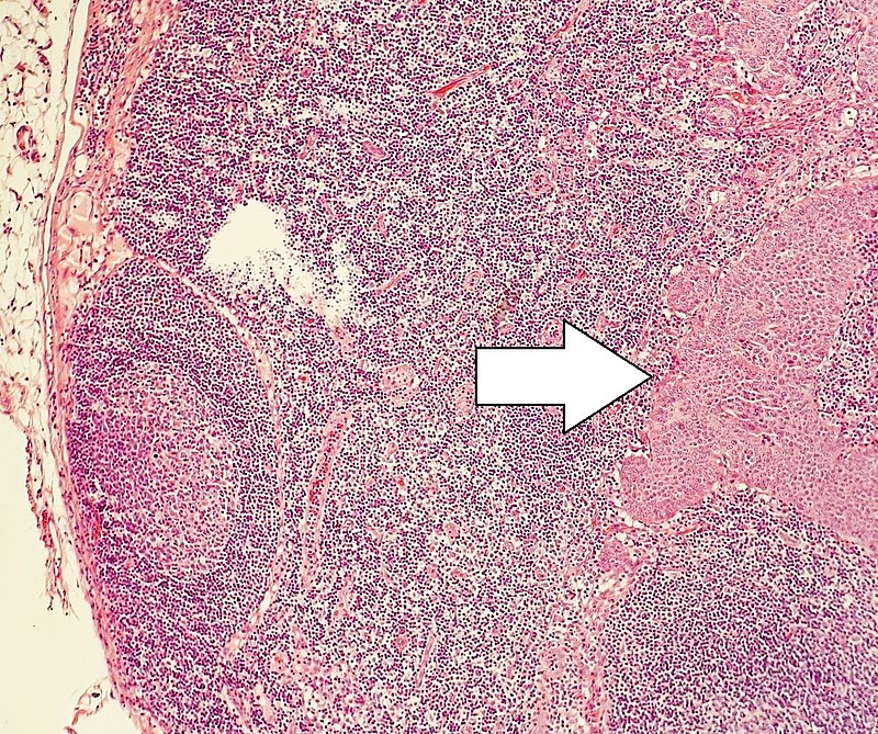 Neuroendocrine Tumor of the Lung
