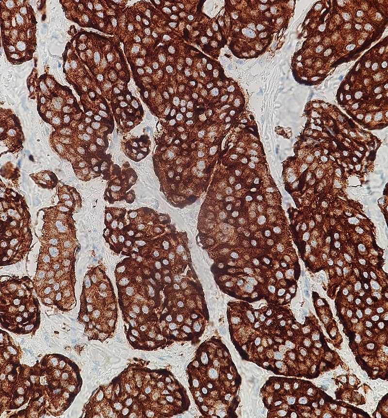 Neuroendocrine Tumor of the Lung