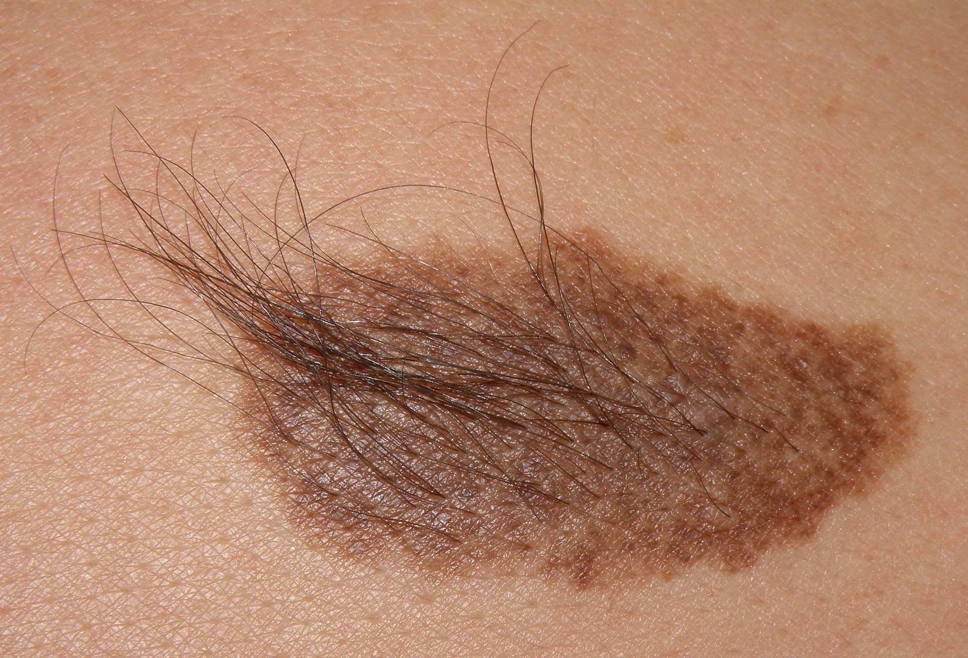 Nevus