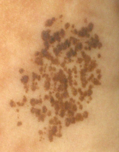 Nevus