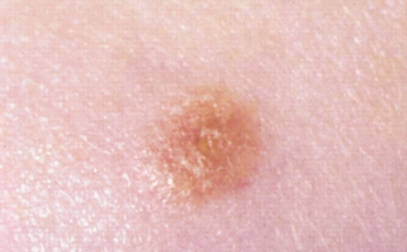 Nevus