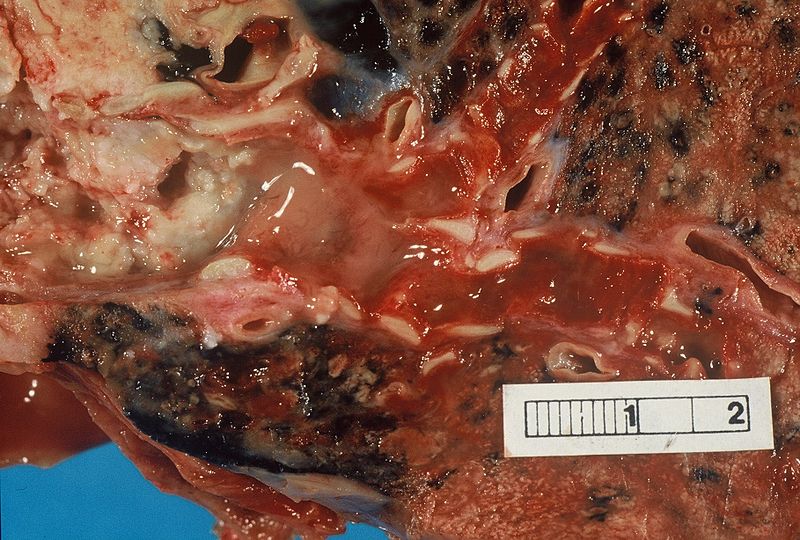 Non-Small Cell Lung Carcinoma.