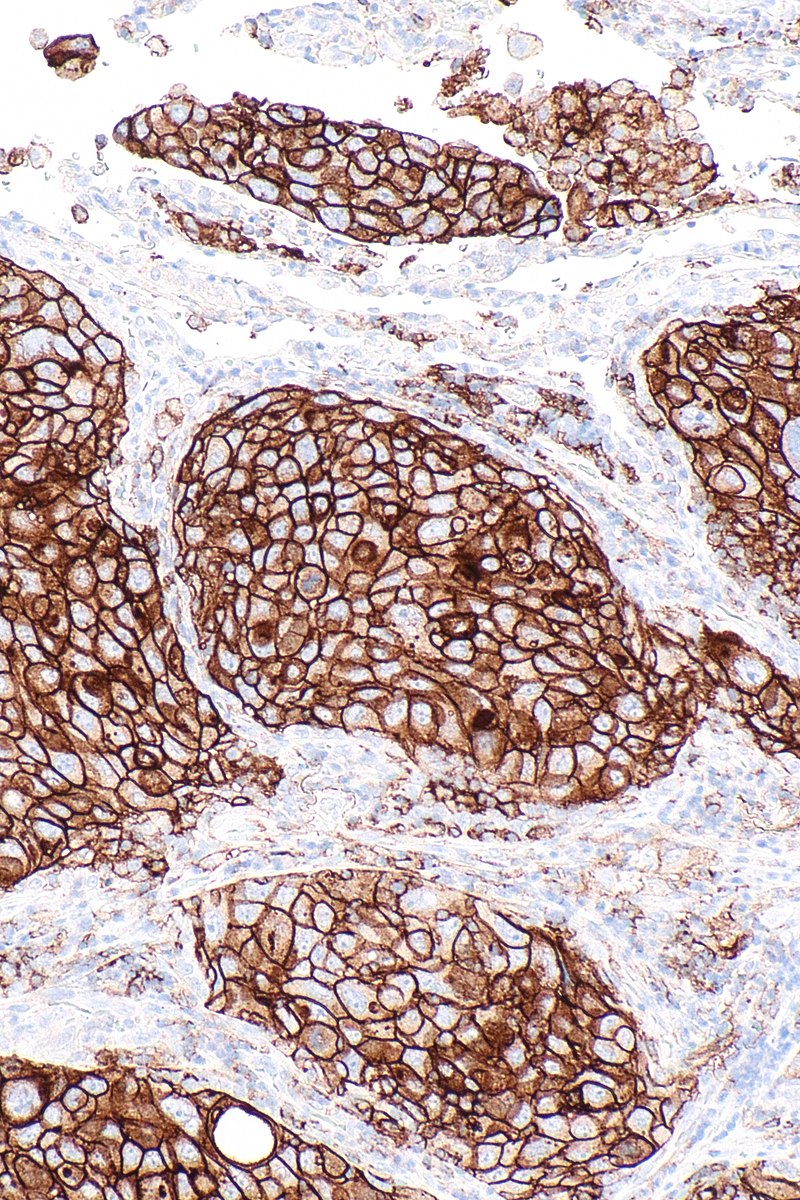 Non-Small Cell Lung Carcinoma