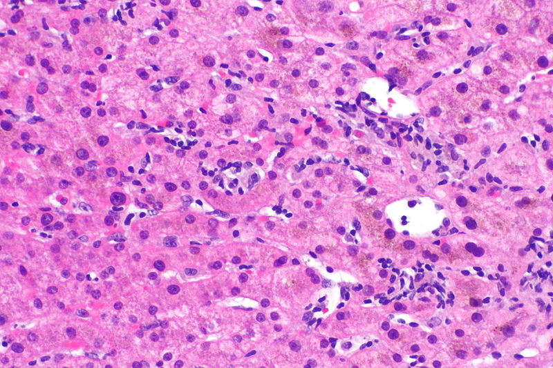 Nonalcoholic Fatty Liver Disease